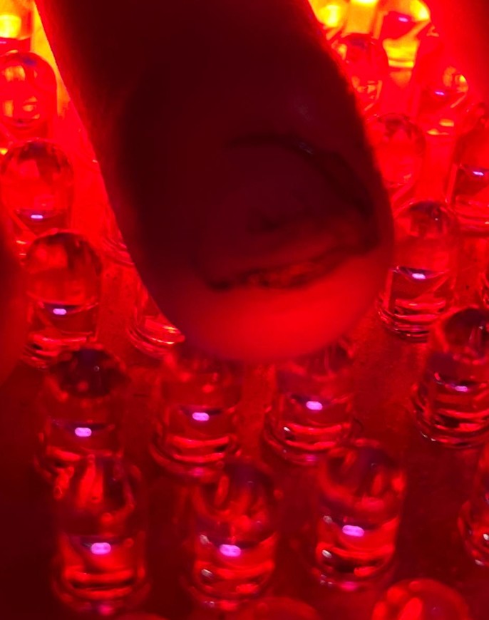 Uña lesionada antes de la terapia