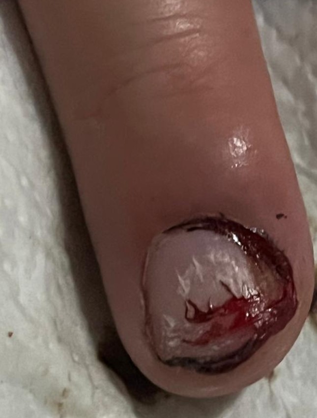 Proceso de cicatrización de la uña